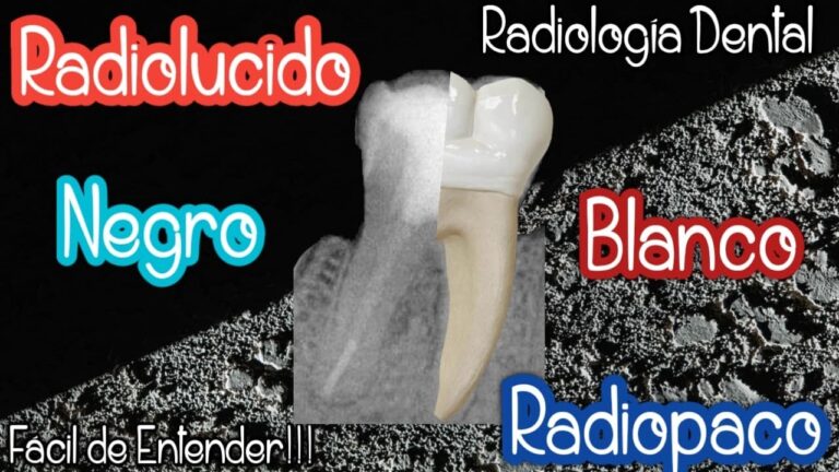 Radiolúcido vs. Radiopaco: Entendiendo sus Diferencias en Imágenes Médicas