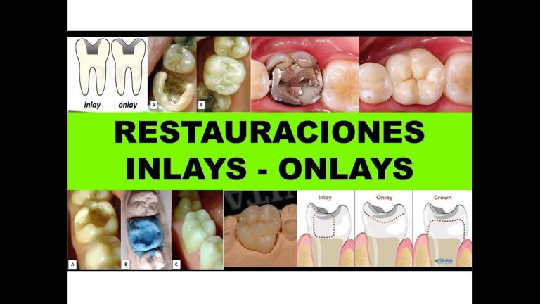 Descubre el Significado de Onlay